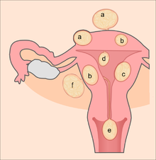 220px-Uterine_fibroids