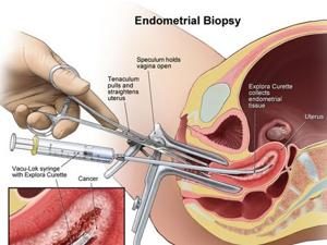 Endometrial biopsy Information