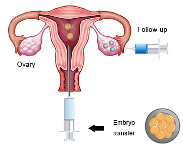 Frozen-Embryo-Transfer-FET