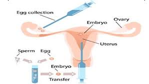 Egg Donor IVF Process in Nepal