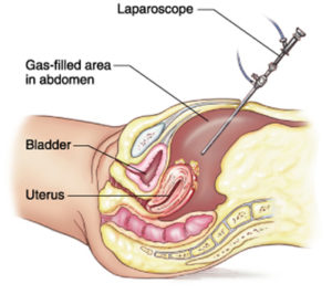 laparoscopy