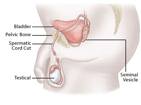 vasectomy_pic