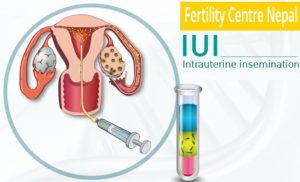 IUI Treatment cost in Nepal