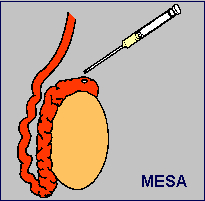 MESA treatment in nepal 