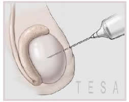 tesa treatment in nepal 