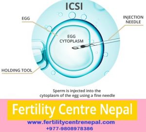 ICSI Treatment Nepal