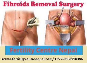 Fibroid Removal Surgery Cost in Nepal