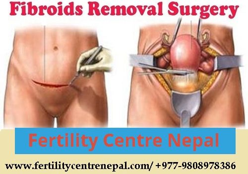 Fibroid Removal Surgery Cost in Nepal