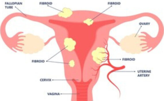 Fibroid Removal Surgery in Nepal