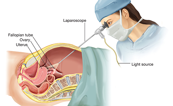 Laparoscopic in Nepal