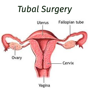 tubal opening surgery cost in Nepal