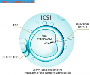 ICSI in Nepal